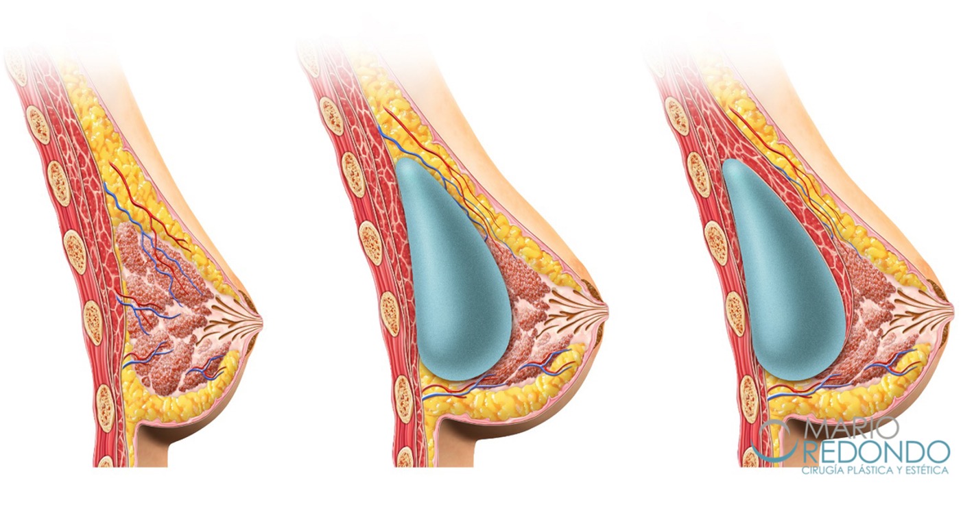 Mamoplastia de aumento